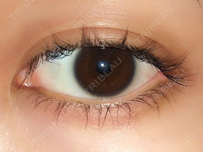 目頭切開 / 目尻切開 エートップ美容整形外科 DAY 261 メイン用