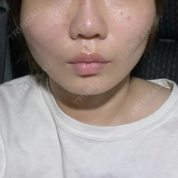 糸リフト / ボトックス（エラ・小顔） TCB東京中央美容外科 静岡院 DAY 0 メイン用