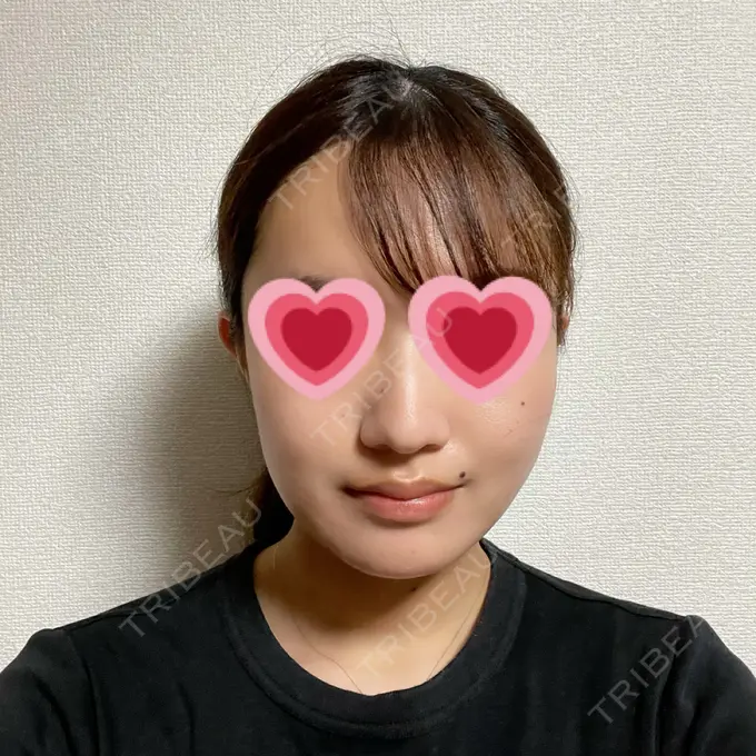 糸リフト / 脂肪吸引（顔） / メーラーファット除去 湘南美容クリニック 秋葉原院 AFTER メイン用