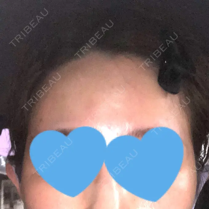 ヒアルロン酸注入（こめかみ） ルラ美容クリニック 渋谷本院 DAY 75 メイン用