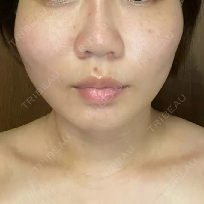 糸リフト / ボトックス（エラ・小顔） TCB東京中央美容外科 静岡院 DAY 1 メイン用