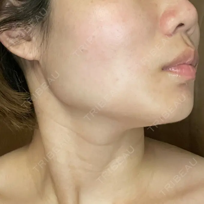 糸リフト / ボトックス（エラ・小顔） TCB東京中央美容外科 静岡院 DAY 1 メイン用