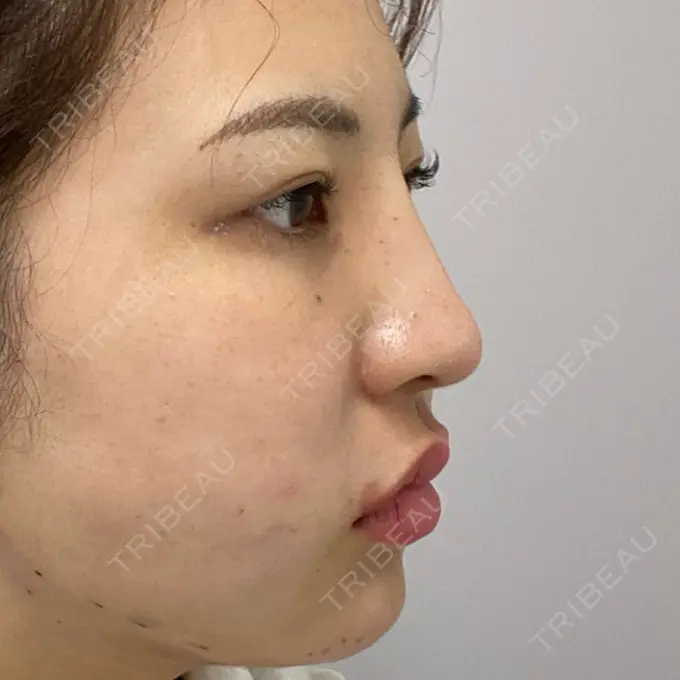 ヒアルロン酸注入（鼻） TCB東京中央美容外科 八王子院 DAY 0 メイン用