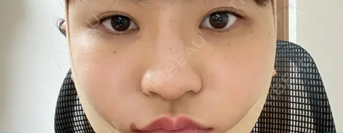 ヒアルロン酸注入（鼻） TCB東京中央美容外科 八王子院 DAY 1 メイン用