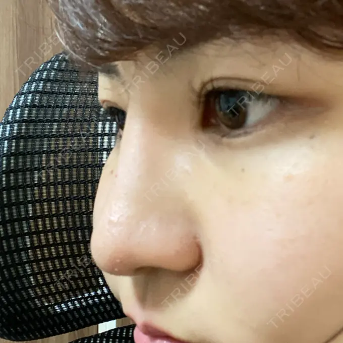 ヒアルロン酸注入（鼻） TCB東京中央美容外科 八王子院 DAY 1 メイン用