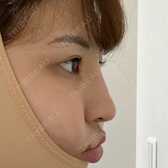 ヒアルロン酸注入（鼻） TCB東京中央美容外科 八王子院 DAY 1 メイン用