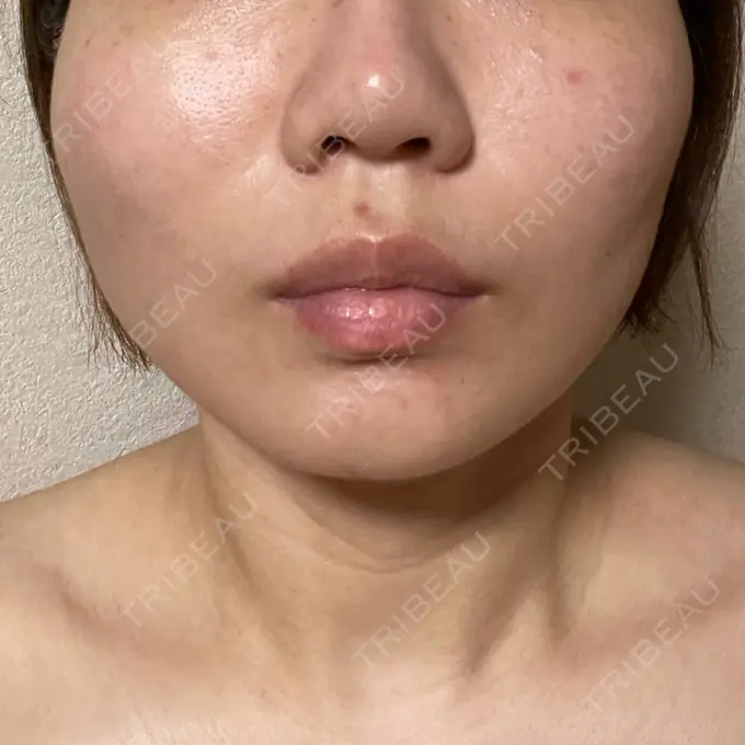 糸リフト / ボトックス（エラ・小顔） TCB東京中央美容外科 静岡院 DAY 2 メイン用