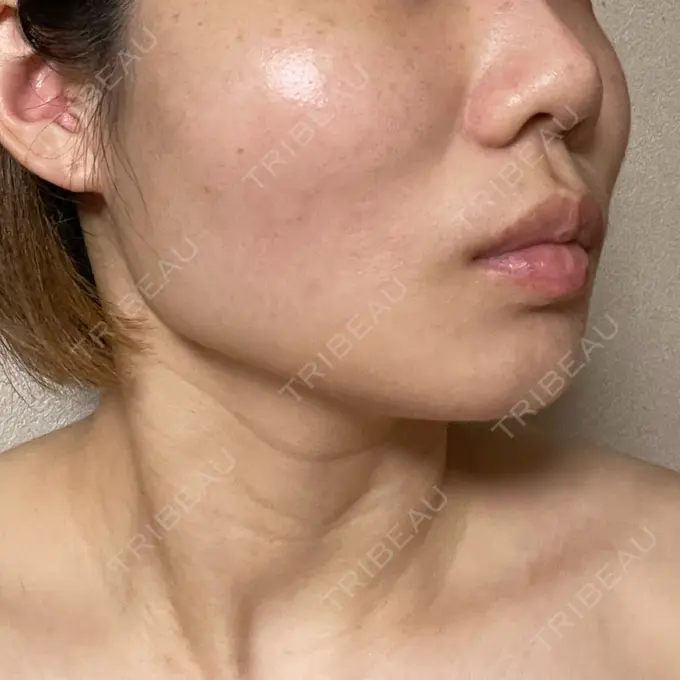 糸リフト / ボトックス（エラ・小顔） TCB東京中央美容外科 静岡院 DAY 2 メイン用