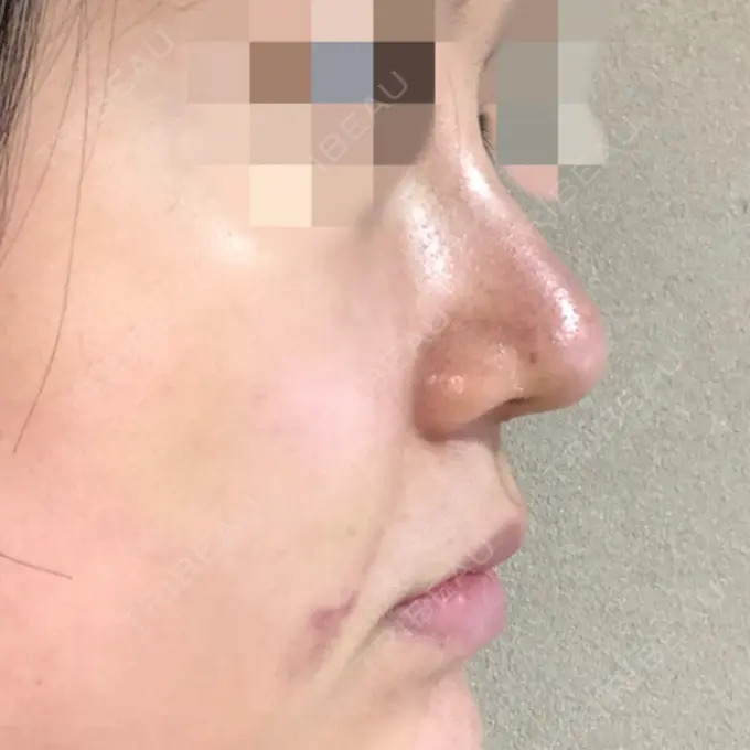 隆鼻術 / 鼻尖形成（切開） トップフェイス整形外科 DAY 10 メイン用