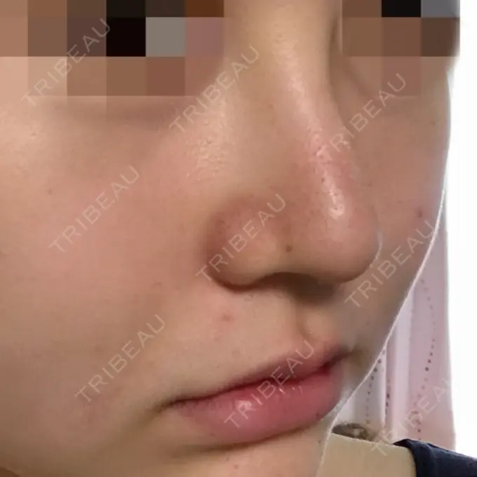 隆鼻術 / 鼻尖形成（切開） トップフェイス整形外科 DAY 10 メイン用