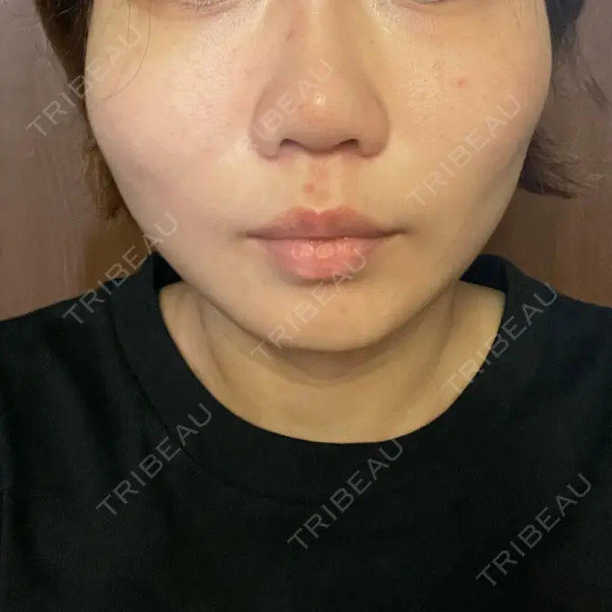 糸リフト / ボトックス（エラ・小顔） TCB東京中央美容外科 静岡院 DAY 3 メイン用