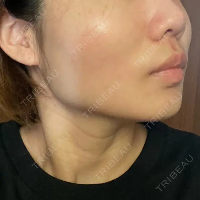 糸リフト / ボトックス（エラ・小顔） TCB東京中央美容外科 静岡院 DAY 3 メイン用