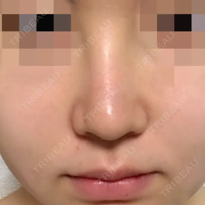 隆鼻術 / 鼻尖形成（切開） トップフェイス整形外科 DAY 10 メイン用