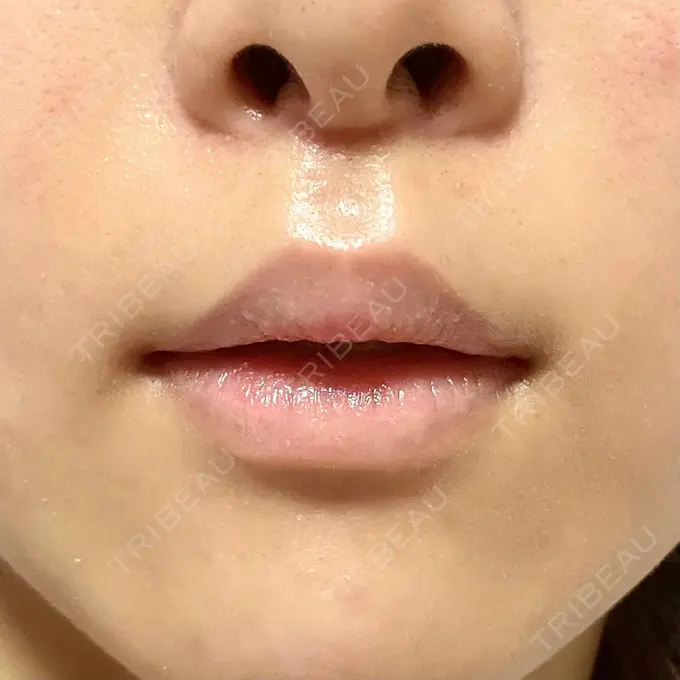 人中短縮 新宿ラクル美容外科クリニック 新宿院 DAY 44 メイン用