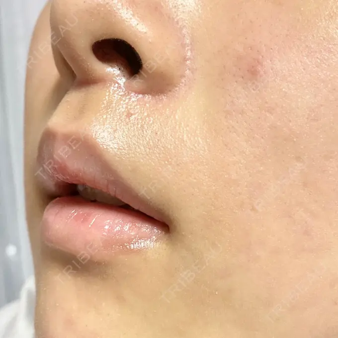 人中短縮 新宿ラクル美容外科クリニック 新宿院 DAY 44 メイン用