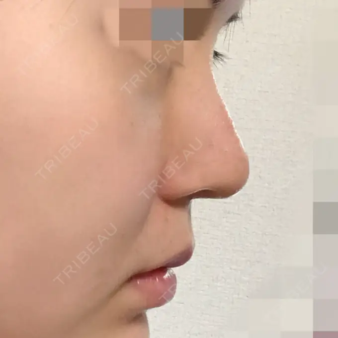 隆鼻術 / 鼻尖形成（切開） トップフェイス整形外科 DAY 14 メイン用