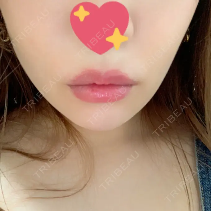 ヒアルロン酸注入（唇） / ボトックス（口角） id美容クリニック 銀座院 DAY 0 メイン用