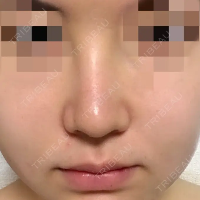 隆鼻術 / 鼻尖形成（切開） トップフェイス整形外科 DAY 14 メイン用