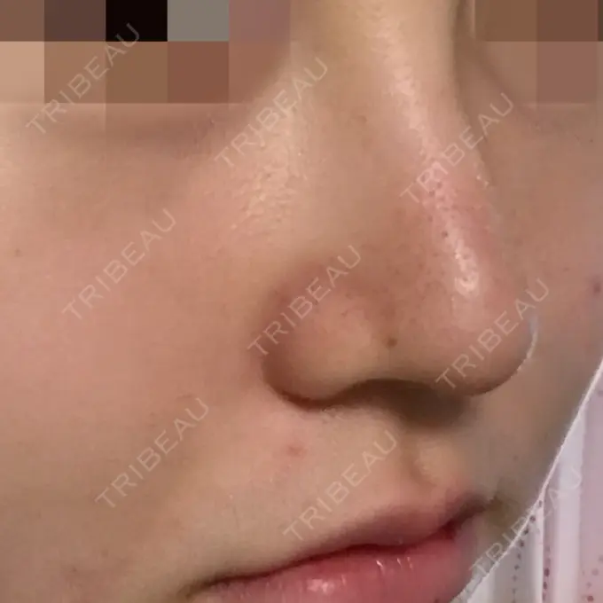 隆鼻術 / 鼻尖形成（切開） トップフェイス整形外科 DAY 14 メイン用