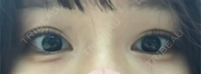 ヒアルロン酸注入（涙袋） フィラークリニック 横浜院 DAY 107 メイン用