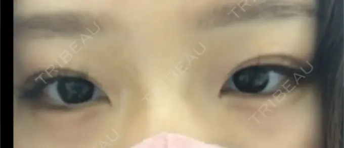 ヒアルロン酸注入（涙袋） フィラークリニック 横浜院 DAY 107 メイン用