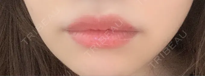 ヒアルロン酸注入（唇） / ボトックス（口角） id美容クリニック 銀座院 DAY 1 メイン用