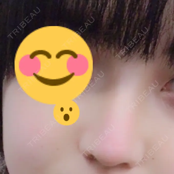 隆鼻術 / 鼻尖形成（切開） トップフェイス整形外科 AFTER メイン用