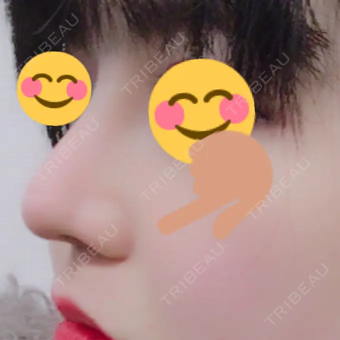 隆鼻術 / 鼻尖形成（切開） トップフェイス整形外科 DAY 23 メイン用