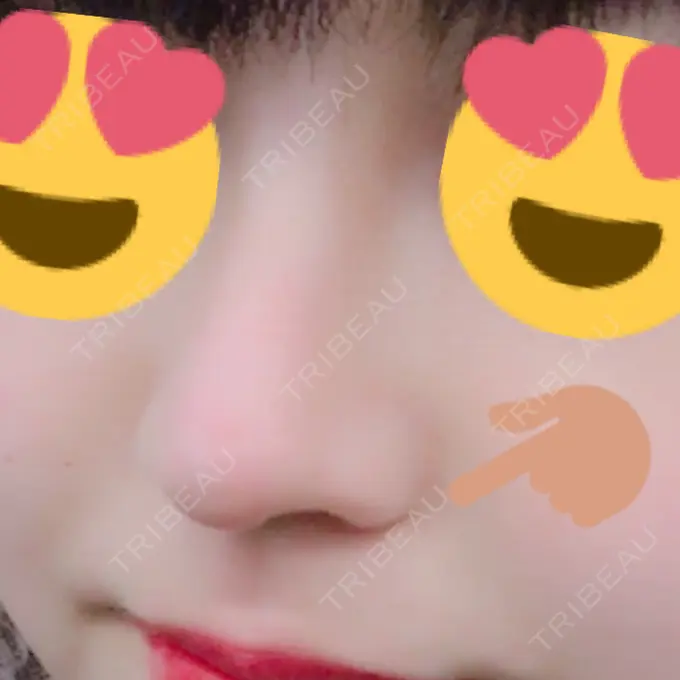 隆鼻術 / 鼻尖形成（切開） トップフェイス整形外科 DAY 23 メイン用