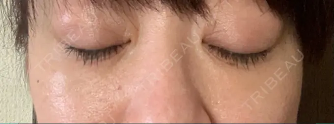 下まぶたたるみ取り / 下まぶたの脂肪取り セオリークリニック DAY 61 メイン用