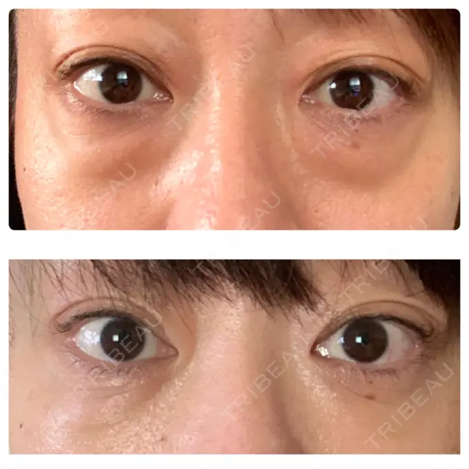 下まぶたたるみ取り / 下まぶたの脂肪取り セオリークリニック DAY 61 メイン用