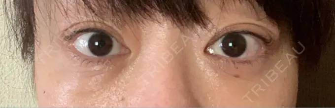 下まぶたたるみ取り / 下まぶたの脂肪取り セオリークリニック DAY 61 メイン用