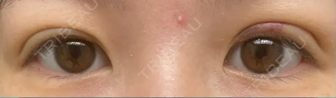 二重埋没 湘南美容クリニック 東京蒲田院 DAY 11 メイン用