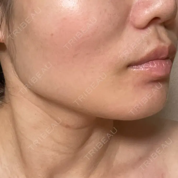 糸リフト / ボトックス（エラ・小顔） TCB東京中央美容外科 静岡院 DAY 7 メイン用