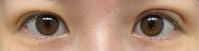 二重埋没 湘南美容クリニック 東京蒲田院 DAY 12 メイン用