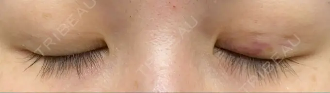 二重埋没 湘南美容クリニック 東京蒲田院 DAY 12 メイン用