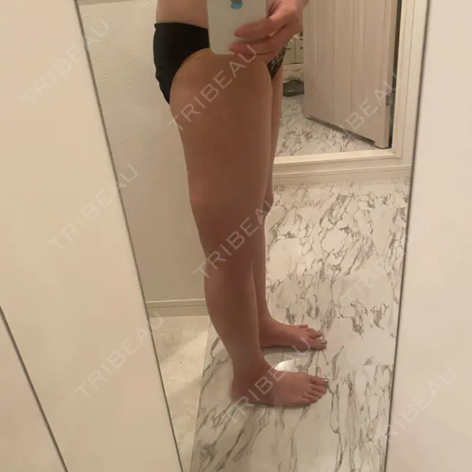 脂肪吸引（脚） THE CLINIC（ザ・クリニック） 福岡院 DAY 17 メイン用