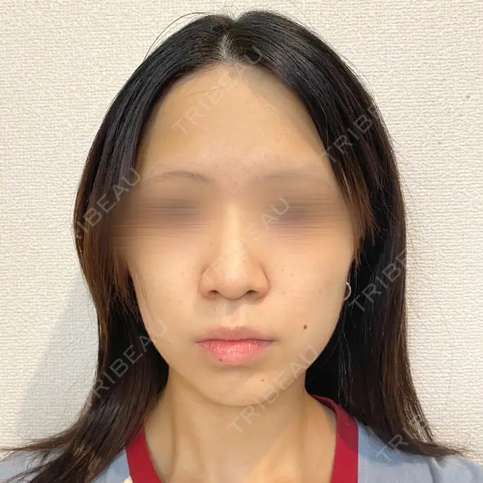 脂肪溶解注射（顔） 新宿美容外科クリニック 新宿院 DAY 1 メイン用