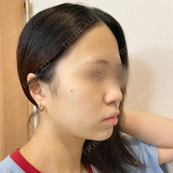 脂肪溶解注射（顔） 新宿美容外科クリニック 新宿院 DAY 1 メイン用