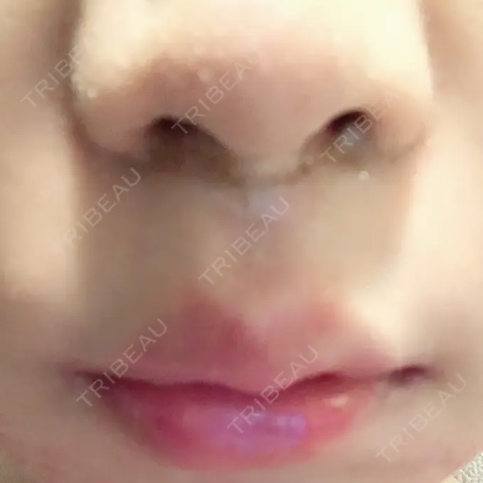 人中短縮 新宿ラクル美容外科クリニック 新宿院 DAY 30 メイン用