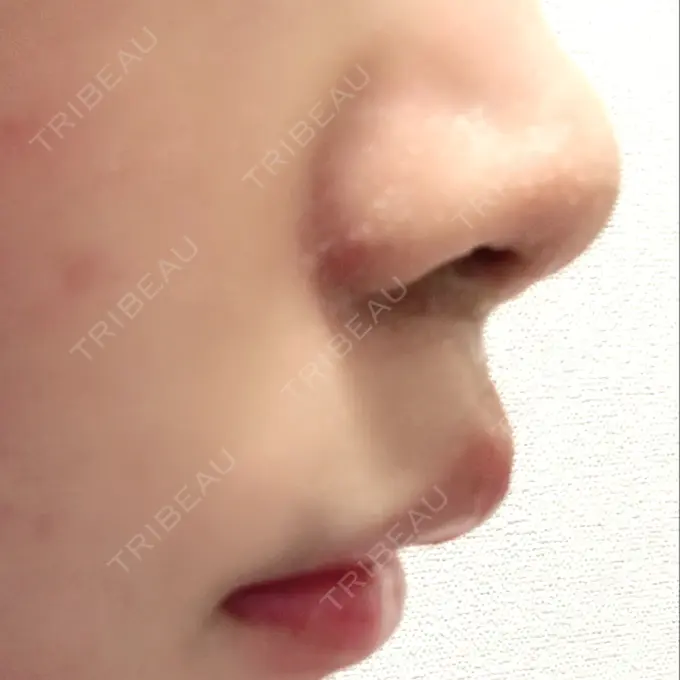 人中短縮 新宿ラクル美容外科クリニック 新宿院 DAY 30 メイン用