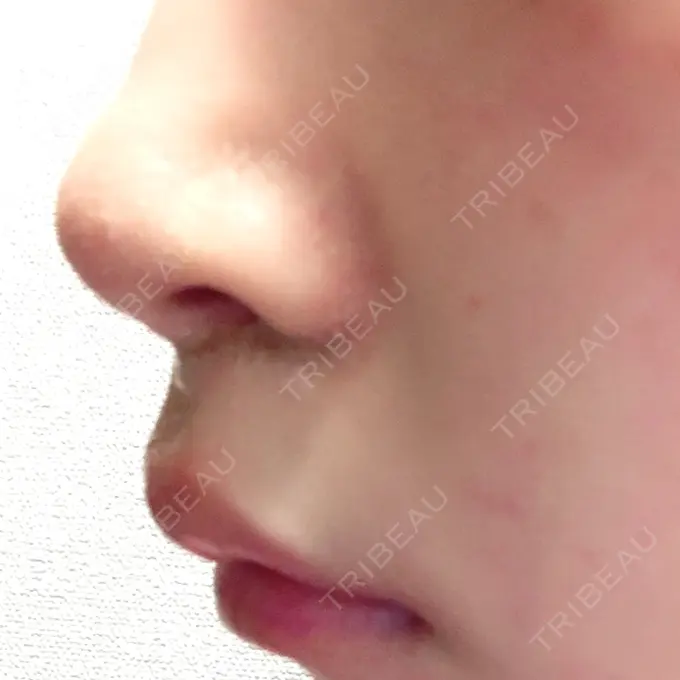 人中短縮 新宿ラクル美容外科クリニック 新宿院 DAY 30 メイン用