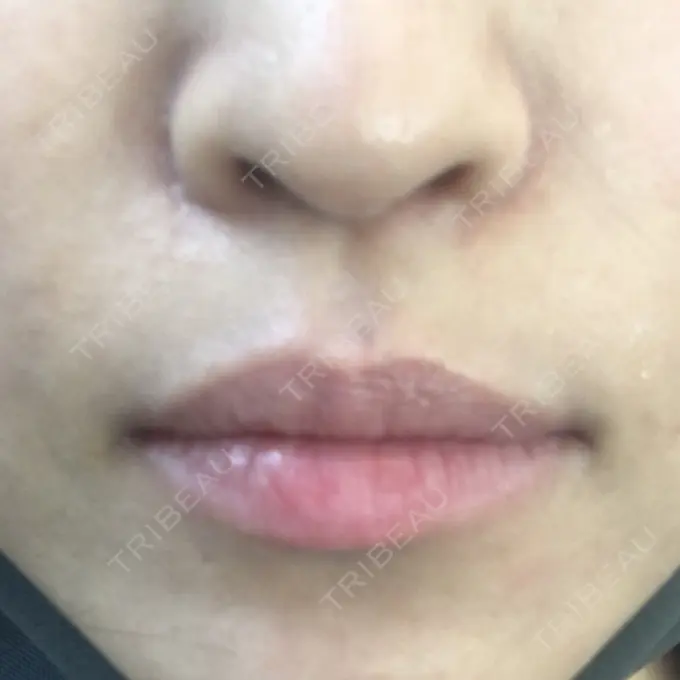 その他（輪郭） TCB東京中央美容外科 堺院 DAY 193 メイン用