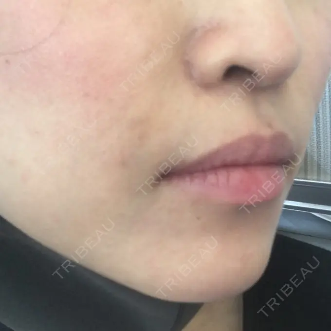 その他（輪郭） TCB東京中央美容外科 堺院 DAY 193 メイン用