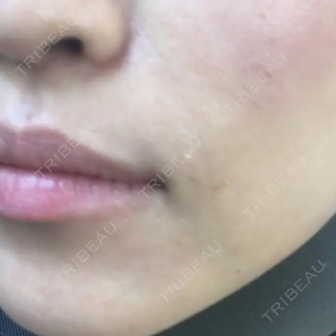 その他（輪郭） TCB東京中央美容外科 堺院 DAY 193 メイン用