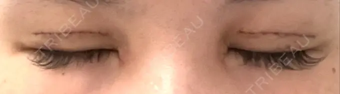 二重切開 / 蒙古ひだ形成 R.O.clinic DAY 6 メイン用