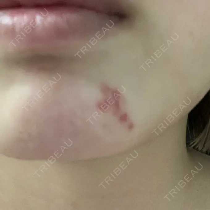 ほくろ・いぼ切除（肌） 新宿新南口れいわクリニック DAY 19 メイン用