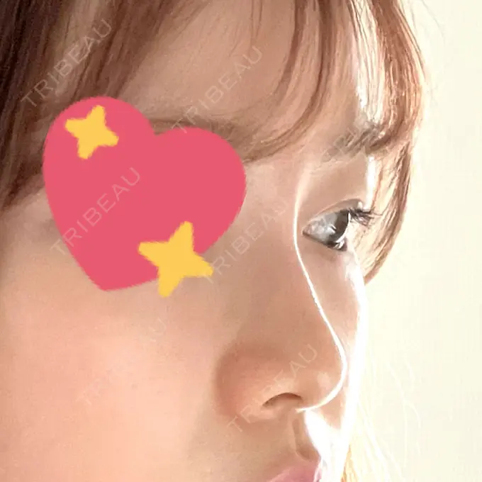 ヒアルロン酸注入（鼻） プライベートスキンクリニック 梅田本院 DAY 0 メイン用