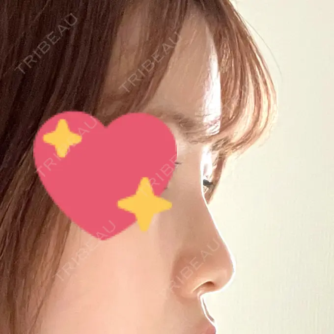 ヒアルロン酸注入（鼻） プライベートスキンクリニック 梅田本院 DAY 0 メイン用