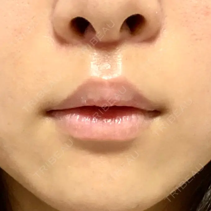 人中短縮 新宿ラクル美容外科クリニック 新宿院 DAY 51 メイン用